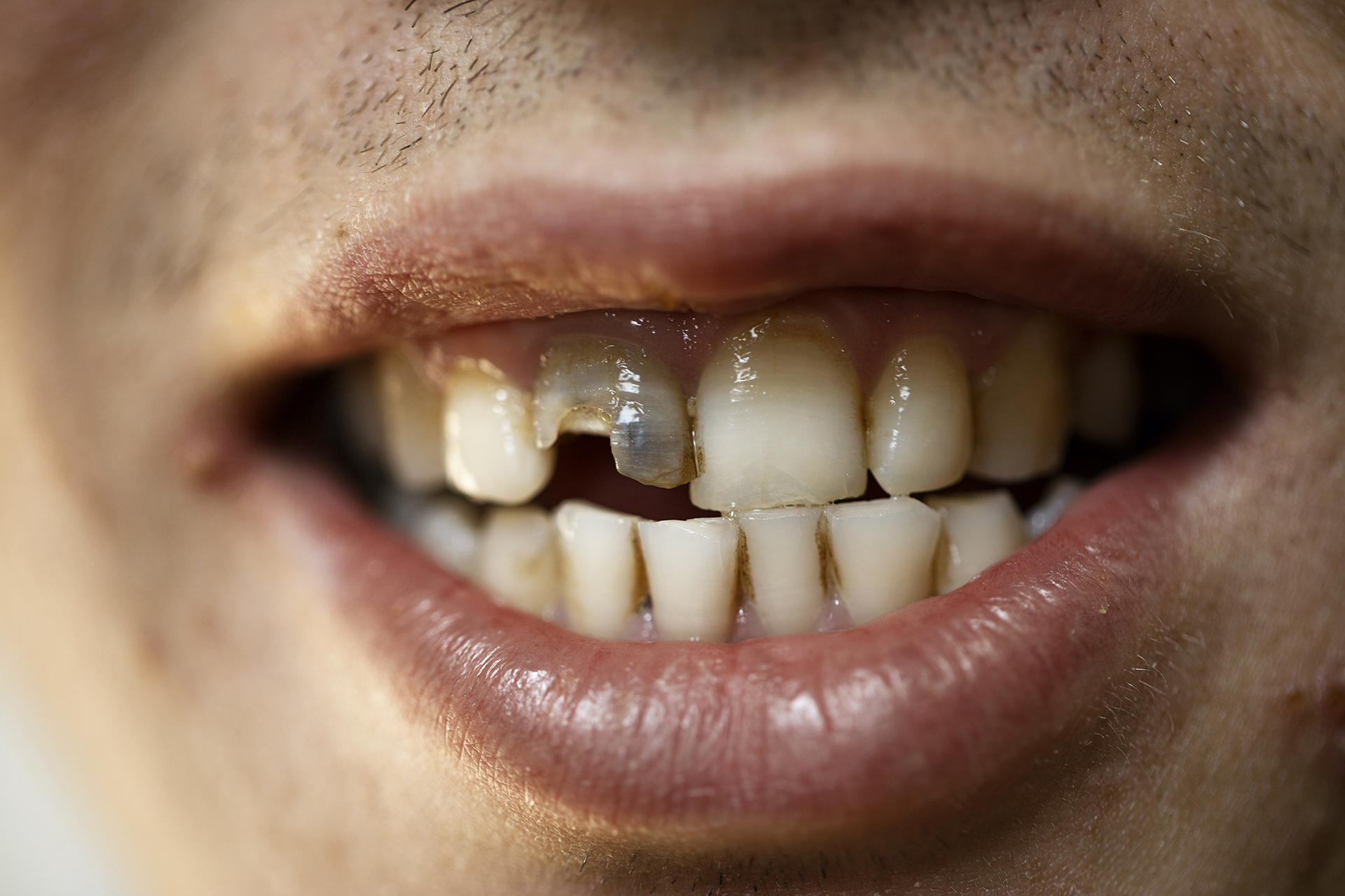 Masoomi Hameed from Afghanistan crushed his tooth when he fell on his escape route